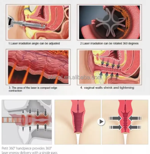 Láser Diodo de 1470nm y 980nm para Ginecología, Tratamiento de Atrofia Vaginal, Fibromas Uterinos, Tratamiento Ovárico, Cirugía Clínica, Hemorroides, EVLT, PLDD, ORL - Product Image 3