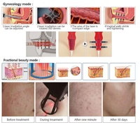 Sannce — laser de rajeunissement de la peau, équipement Portable de beauté pour le resserrement du vagin, machine à raie Co2