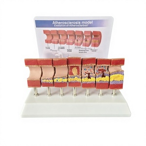 Model Anatomi Aterosklerosis Manusia, Penyumbatan Patologis Intima, Stenosis, Akumulasi Lemak, Jantung Lansia Paruh Baya - Product Image 1