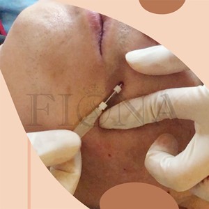 Hilo Multi-Smooth con cánula 19G-38mm para relleno <span class=keywords><strong>de</strong></span> líneas profundas, directo <span class=keywords><strong>de</strong></span> fábrica - Product Image 4