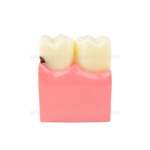 Modello Dentale di Carie per Educazione e Spiegazione ai Pazienti - Product Image 5