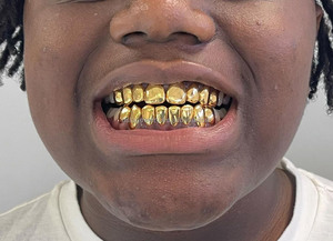 Gioielli Hip Hop Personalizzati, <span class=keywords><strong>Grillz</strong></span> Dentali in Ottone Non Prezioso Placcato Oro per Uomo e Donna - Product Image 4