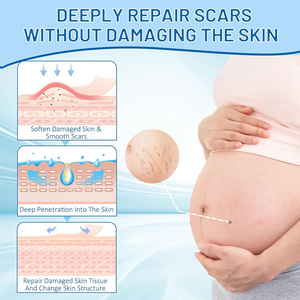 Crema <span class=keywords><strong>para</strong></span> estrías OEM con etiqueta privada, ingredientes naturales <span class=keywords><strong>para</strong></span> la reparación intensiva de la piel, suaviza <span class=keywords><strong>las</strong></span> cicatrices, suaviza <span class=keywords><strong>el</strong></span> cuidado posparto dañado - Product Image 2