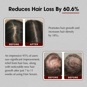 Suero Natural <span class=keywords><strong>para</strong></span> el crecimiento <span class=keywords><strong>del</strong></span> <span class=keywords><strong>cabello</strong></span> de etiqueta privada, <span class=keywords><strong>productos</strong></span> <span class=keywords><strong>para</strong></span> el cuidado <span class=keywords><strong>del</strong></span> cuero cabelludo reparadores <span class=keywords><strong>para</strong></span> <span class=keywords><strong>la</strong></span> caída <span class=keywords><strong>del</strong></span> <span class=keywords><strong>cabello</strong></span>, promueve el crecimiento <span class=keywords><strong>del</strong></span> <span class=keywords><strong>cabello</strong></span>, suero <span class=keywords><strong>para</strong></span> el cuero cabelludo - Product Image 6