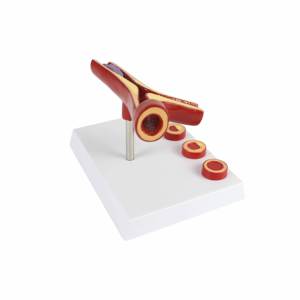 Herramienta de Enseñanza de Educación Médica, Modelo Educativo de <span class=keywords><strong>Arteriosclerosis</strong></span> de 10 Veces el Tamaño Real, Modelo de Arteria - Product Image 4