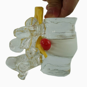 Modelo de Demostración de Extrusión de Columna Vertebral y Médula Espinal, Modelo de Enseñanza Médica Humana, Bola de Burbuja de Médula Espinal - Product Image 2