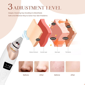 เครื่องดูดสิวเสี้ยนเทคโนโลยีใหม่ล่าสุดสำหรับดูแลผิวหน้า - Product Image 2