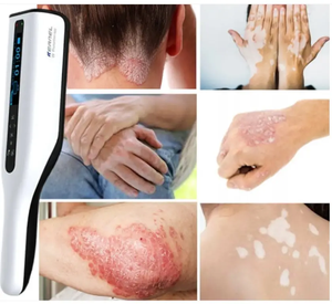 Crème de traitement du <span class=keywords><strong>vitiligo</strong></span> à usage domestique, lumière UV portable, photothérapie à bande étroite 311 nm, appareil de photothérapie UVB pour le <span class=keywords><strong>vitiligo</strong></span> - Product Image 4