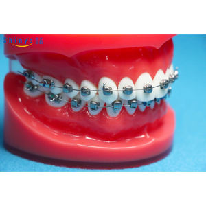 Shinye Trending Produtos New Arrivals Venda quente Moda Brace Orthodont Chaves boca cheia Suspensórios para os dentes - Product Image 1