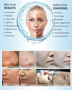 Productos de Tendencia 2026, Equipo de Belleza Renovable con Agua Oxigenada, Máquina de Limpieza Profunda Facial, Aqua Peel Jet, Hidrodermoabrasión - Product Image 3