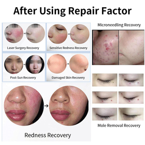 Crema Reparadora de Barrera Facial con EGF de Fábrica OEM, Crema Hidratante Calmante para Piel Dañada, Reparación de Cicatrices, Productos Calmantes con EGF - Product Image 4