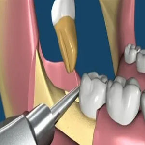 M.A SIDDIQUE INTERNATIONAL 2025, Kit de instrumentos de cirugía Dental de acero Manual, fórceps de elevador, elevador de extracción completamente esterilizado - Product Image 6