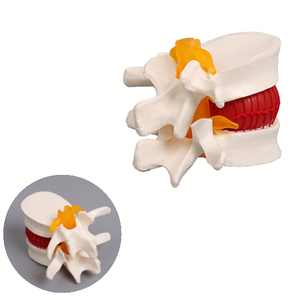 Đĩa Đệm Thắt Lưng Người Mô Hình Bệnh Lý Thoát Vị Mô Hình Đĩa Đệm - Product Image 1