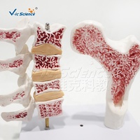 Modelo de Lesión de Osteoporosis en 2 Partes: Columna Vertebral y Fémur Proximal Patológicos, PVC Pintado a Mano, Ideal para la Educación del Paciente