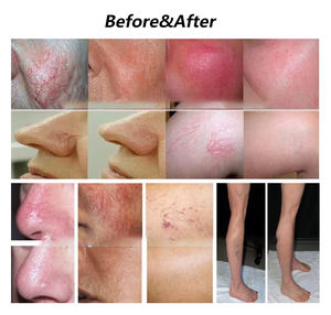 Mesin elektrolisis RBS profesional penghilang rambut/pembuluh darah/Nevus/Verruca pigmen & Pengobatan Spot usia penghilang pembuluh laba-laba - Product Image 6