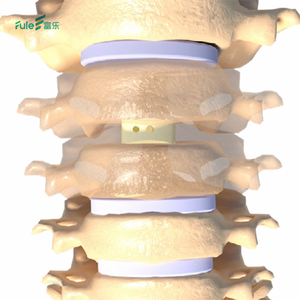 กรงกระดูกสันหลังส่วนคอ PEEK คุณภาพสูงแบบรุกรานต่ำสำหรับการผ่าตัดกระดูกสันหลัง ขายส่ง - Product Image 2