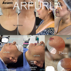 Endoláser 2026 de Última Generación 980nm 1470nm para Lifting Facial y Lipólisis, Eliminador de Grasa - Product Image 4