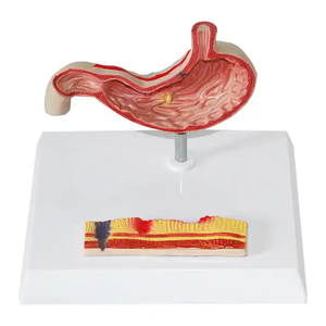 Equipo de enseñanza médica, ciencia médica, modelo de órgano humano patológico gástrico, modelo de anatomía, modelo de estómago - Product Image 1
