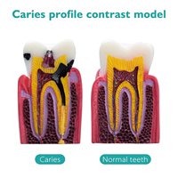 Modelo Educativo de Anatomía de Caries Dentales, Plástico, 6 Secciones Transversales, Demostraciones de Comparación Bilateral, Estudio de Ciencias Médicas