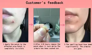 Star Hydrocolloid Acne Pimple Patch Supplier For Face Clear And Make-Up