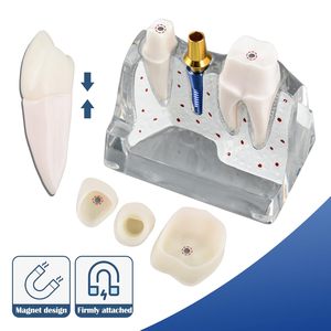 Modèle d'implant dentaire pour l'éducation des patients, modèle d'implant dentaire, de couronne et de pont 4 fois plus grand pour la présentation - Transparent - Product Image 2