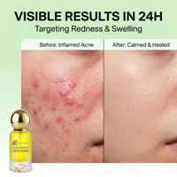 Sérum Apaisant & Réparateur Éclaircissant Anti-Acné à la Centella Asiatica, Vitamine B5 et Acide Hyaluronique 30ml Liquide pour Visage et Nez OEM/ODM