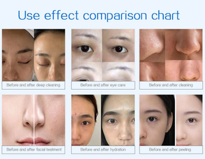 Máquina Facial de Microdermoabrasión 18 en 1 con Oxígeno, Eliminación de Puntos Negros, Limpieza Facial, Máquina de Belleza Facial - Product Image 5