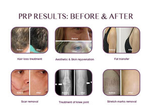 12ml 프리미엄 미니 PRP 키트 얼굴 치료를 위한 젊음의 광채를 깨우다 - Product Image 5