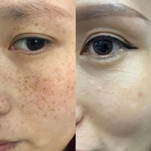 Crema Correctora de Manchas Oscuras + Bálsamo Reparador de Piel con Bisabolol para el Tratamiento de Manchas Oscuras, Crema Tópica para Eliminar Pecas y Manchas - Product Image 3