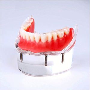 KyrenMed-Localisateur dentaire à quatre implants, modèle de prothèse inférieure, dents amovibles, modèle <span class=keywords><strong>mandibulaire</strong></span> - Product Image 3