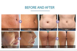 Produits Tendances 2026 : Appareil Minceur Vela, Rouleau Anti-Cellulite, Masseur Anti-Cellulite, Appareil de Remodelage Corporel et de Beauté - Product Image 6