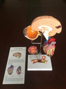 Modelo Anatómico de Cerebro Humano en Escala 1:1 de PVC con Modelo de Anatomía Patológica Hipertensiva - Product Image 3