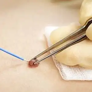 جهاز تكتفول PD702B من الفئة الثالثة لشفط الدخان الطبي، جهاز كهربائي معتمد من <span class=keywords><strong>CE</strong></span> للجراحة التجميلية مع ضمان لمدة سنة واحدة - Product Image 6