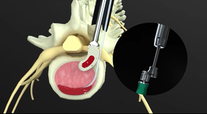 Perangkat Fusi <span class=keywords><strong>Interbody</strong></span> Lumbar Ortopedi Posterior Kelas III Berlabel CE Fule, Garansi Lebih Dari 5 Tahun, Material PEEK - Product Image 4