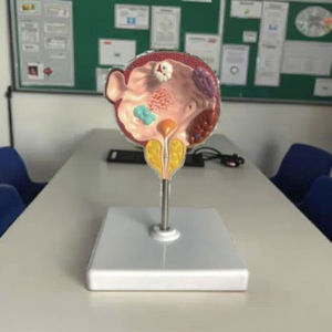 Enfermedades <span class=keywords><strong>de</strong></span> la vejiga y la próstata, modelo <span class=keywords><strong>de</strong></span> anatomía humana médica, patologías del sistema urinario masculino - Product Image 5