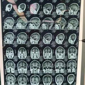 16 canais monitoramento intraoperatório sistema IONM médico profissional sistema neuromonitoring intraoperatório - Product Image 5