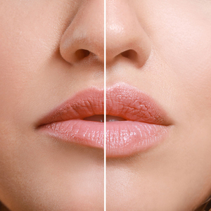 5ml OEM HA Hialuronón para Rostro, Labios, Nariz, Mejillas, Mentón, Pliegues Nasolabiales, Línea de la Mandíbula, Senos y Glúteos |   <span class=keywords><strong>Precio</strong></span> de Fábrica al por Mayor - Product Image 1