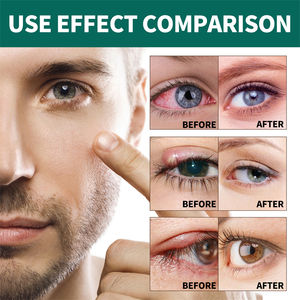 Rouleau South Moon de Soin Ophthalmique pour Traitement par Acupression Visuelle Améliorant la Clarté Visuelle et Soulageant l'Inconfort Oculaire - Product Image 3