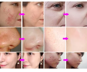 Yeni 360 dönebilir ekran kristal mikrodermabrazyon hidro dermabrazyon hydra oxigen yüz makinesi 14 in 1