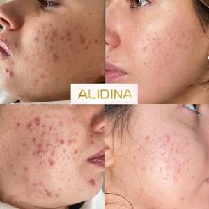 2026 Meilleures ventes : Éponges <span class=keywords><strong>BIO</strong></span> à spicules de <span class=keywords><strong>silice</strong></span>, alternative aux micro-aiguilles traditionnelles, pour traitement méso stimulant la derme et la surface cutanée - Product Image 5