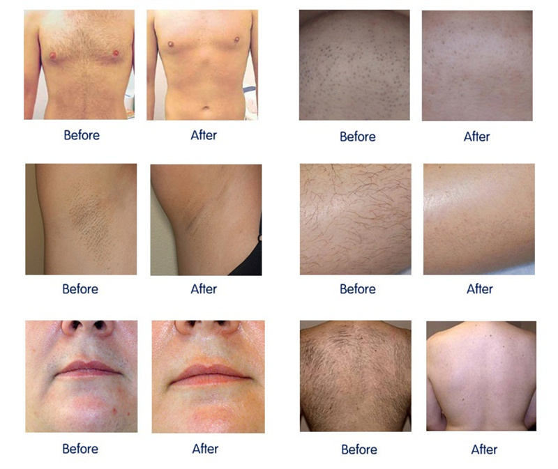 2022z Professional IPL Hair Removal Machine 360 Magneto-optic SHR OPT Laser Hair Removal Acne Treatment Beauty Equipment