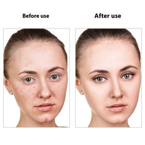 Venta al por mayor Microneedle Acné Parche Agua Coloide Mejora Amor Parche Ácido Hialurónico Pus Belleza Cuidado Personal - Product Image 3