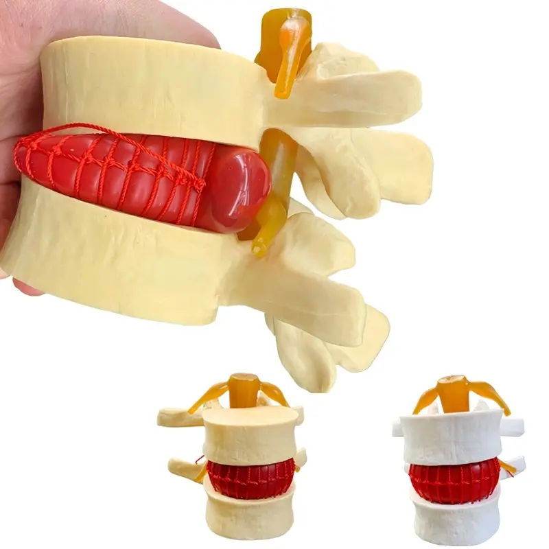 Tıbbi öğretim için insan lomber intervertebral disk sıkıştırma gösteri modeli