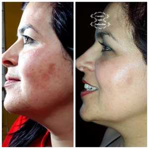 CDT Carboxiterapia ekipmanları 48 saat nakliye <span class=keywords><strong>CO2</strong></span> karboksiterapi makinesi güzellik salonu kullanımı için - Product Image 5