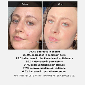 Suero para el Tratamiento del Acné, Peeling Rojo para el Acné con Ácido Succínico, Corrección de Cicatrices de Acné, Eliminación de Imperfecciones Faciales - Product Image 6