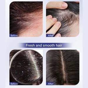 Shampooing Anti-fongique Marque Blanche Traitement Acide Salicylique pour Cuir Chevelu Gras, Dermatite Séborrhéique, Folliculite et <span class=keywords><strong>Psoriasis</strong></span> - Product Image 5