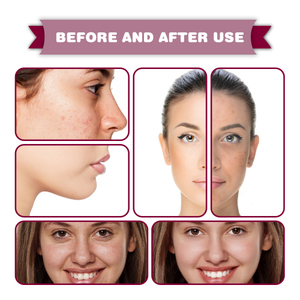 Jaysuing Acid Essence reduce los poros elimina los puntos negros, espinillas y marcas de acné ilumina el tono de la piel hidratante - Product Image 3