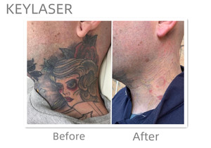 Vente flash - <span class=keywords><strong>Machine</strong></span> portable de suppression de tatouages au laser Nd Yag Q-Switched Picoseconde - 3 longueurs d'onde, dont 755 nm - Meilleur <span class=keywords><strong>prix</strong></span> - Product Image 4