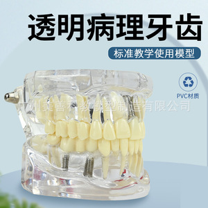 Modelos dentales, modelos de patología dental transparentes naturales, modelos de patología dental y modelos médico-paciente. - Product Image 1