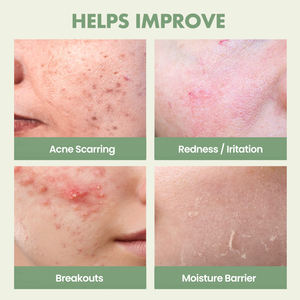 20กรัมเจลกำจัด<span class=keywords><strong>สิว</strong></span>น้ำมันทีทรีสิวกำจัดสิวอย่างรวดเร็วฉลากส่วนตัวกำหนดเองได้อย่างมีประสิทธิภาพ - Product Image 4